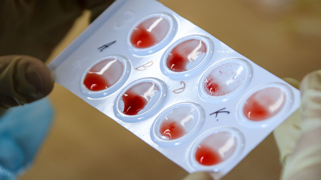 Боковой амиотрофический склероз можно определить по анализу крови