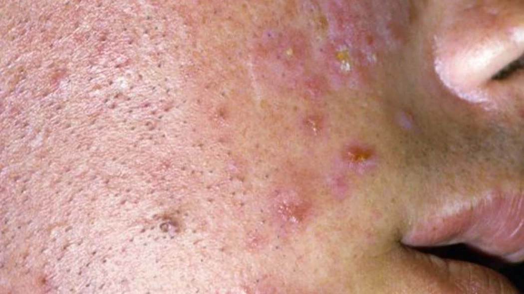 Как избавиться от высыпаний на лице за 10 дней